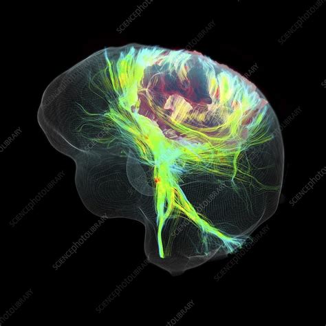 Glioblastoma Brain Tumour Dti Mri Scan Stock Image C