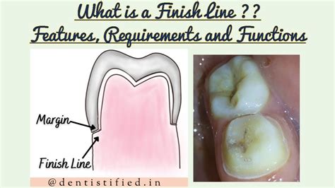 Finish Lines In Fixed Partial Denture Finish Lines In Tooth