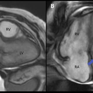 Cardiac Mri Tissue Characterization The Left Atrial Mass Blue Arrows