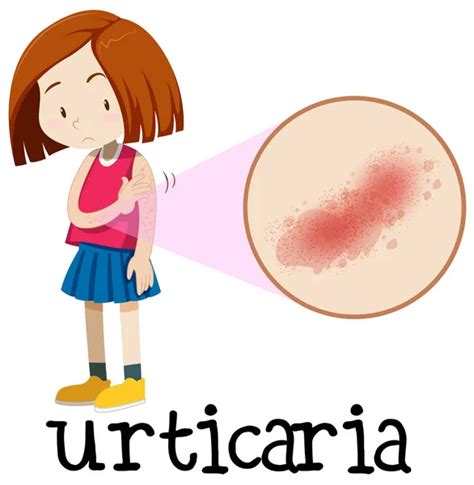 Urticaria Imágenes De Stock De Arte Vectorial Depositphotos