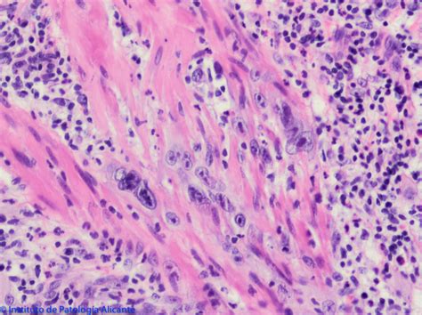 Carcinoma De Células Escamosas Cutáneo Instituto De Patología Alicante