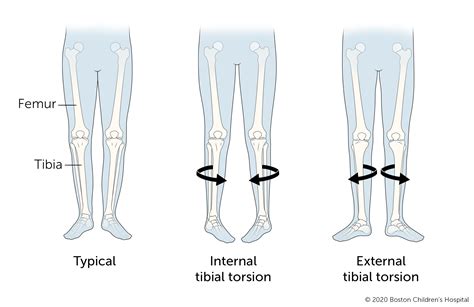 Walking (Gait) Abnormalities | Boston Children's Hospital