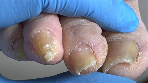 Super Thick Onychomycosis Cut Off Bit By Bit Youtube