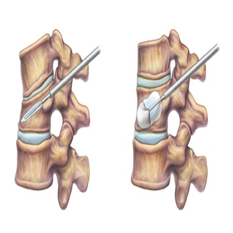 Kyphoplasty Vertebroplasty Empire Spine And Pain