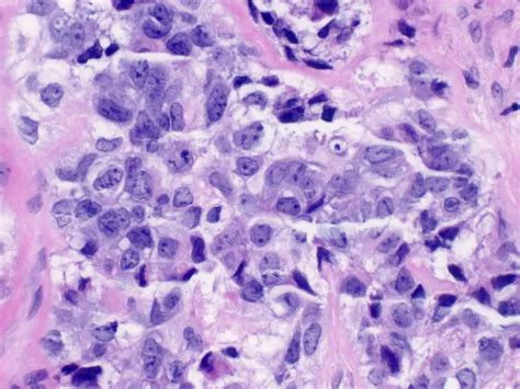 Epithelial Myoepithelial Carcinoma