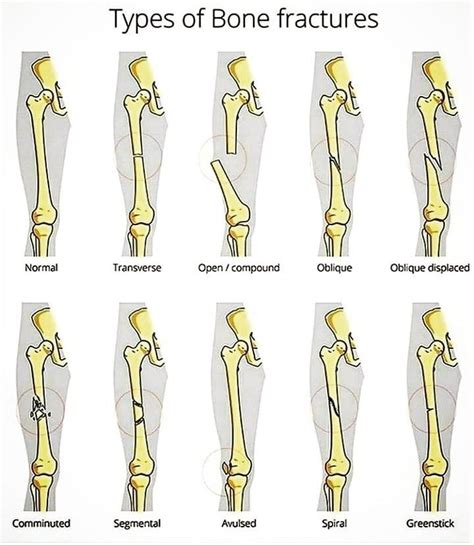 Different types of bone fracture - advisortery