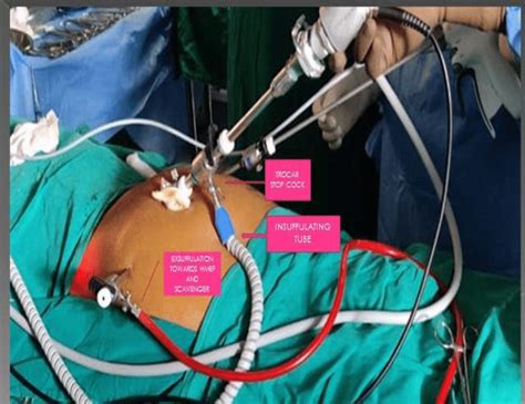 Live Setup Of The CCS Seen During A Laparoscopic TAPP Hernia Surgery