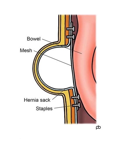 Incisional Hernia Recovery Time