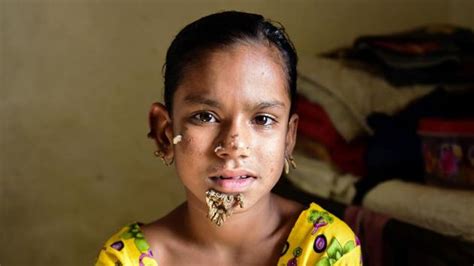 Tree man syndrome: Bark-like warts sprout from face of 10-yr girl in ...