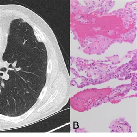 A Ct Scan Showing A 28 Cm Ground Glass Opacity Nodule In The Right Download Scientific