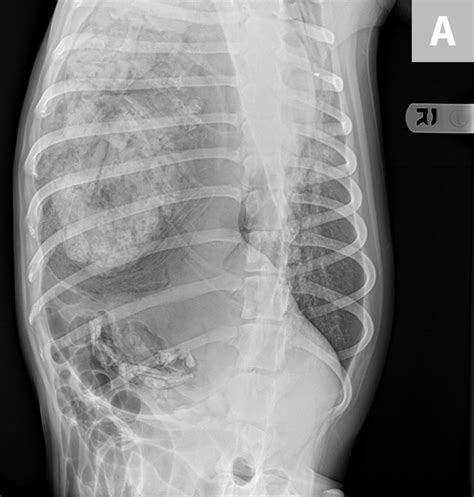 Surgical Repair of Traumatic Diaphragmatic Hernia | Clinician's Brief