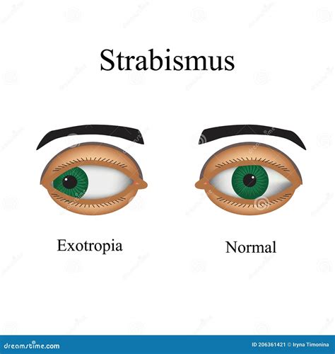 Diseases Of The Eye Strabismus A Variation Of Strabismus Exotropia Stock Illustration