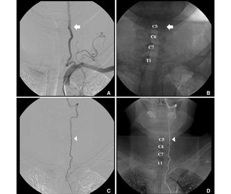 Left Subclavian Artery Angiograms Anteroposterior View A And B Of