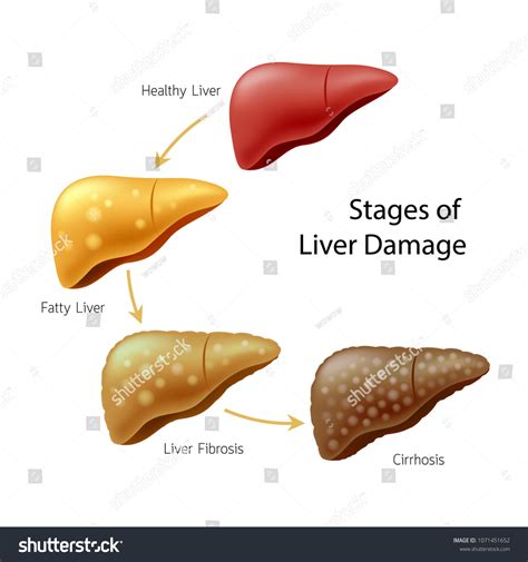 Stages Liver Damage Liver Disease Healthy Stock Vector Royalty Free