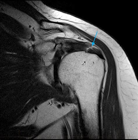 Supraspinatus Tendon Mri Sexiz Pix