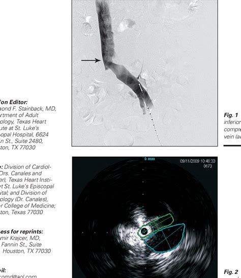 Figure From Intravascular Ultrasound Guidance In Treating May Thurner