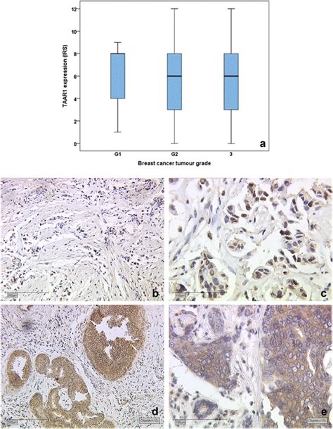 A Expression Of Taar1 In Different Breast Cancer Types Classified By