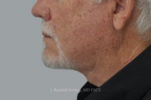 Neck Lift Archives Faces Pllc In Ridgeland Ms