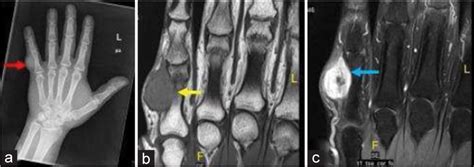 Glomus Tumor Finger Mri