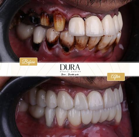 Treating the nerve - عيادات ديورا