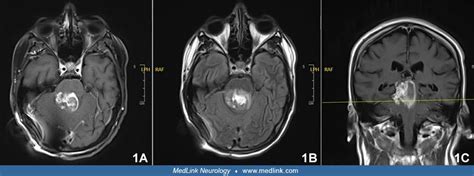 High Grade Midline Glioma With Histone Mutation Medlink Neurology