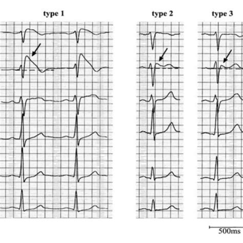 Case Report—Pediatric Brugada Phenotype from Accident Cocaine Ingestion - JETem