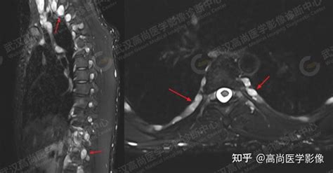 26岁男性患者，神经纤维瘤病1型一例 知乎