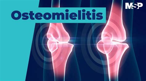 Osteomielitis Youtube