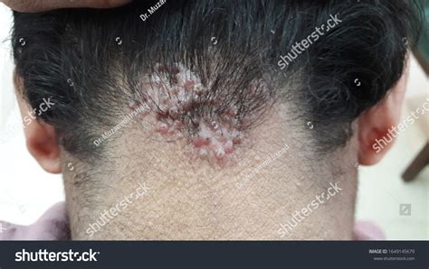 1 Acne Keloidalis Nuchae Images, Stock Photos, 3D objects, & Vectors ...