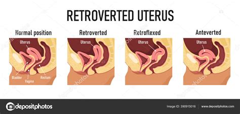 Como E A Gravidez De Quem Tem Útero Retrovertido