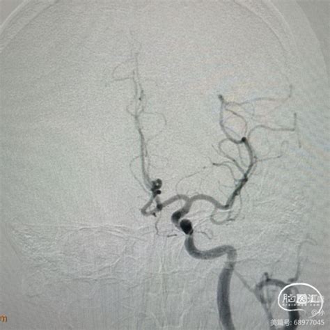 双侧椎动脉夹层动脉瘤介入手术 脑医汇 神外资讯 神介资讯