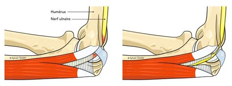 Compression Du Nerf Ulnaire Cubital Au Coude Institut De Chirurgie