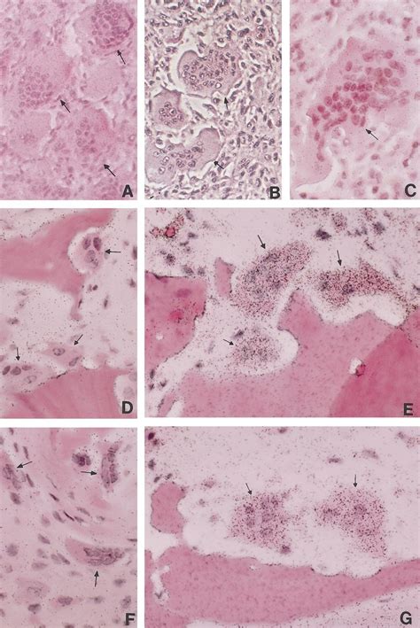 Il 8 Mrna Expression Detected In Resorbing Hoc By In Situ Hybridization