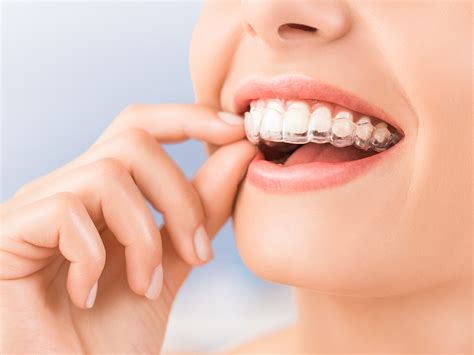 How Can You Tell If Invisalign Is Working