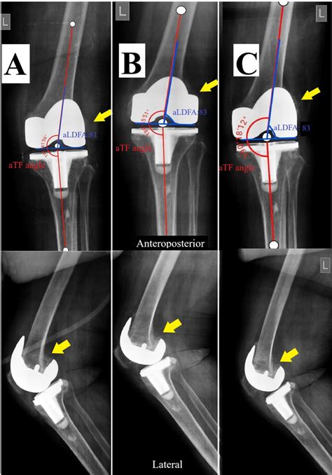 Figure From Nonsurgical Management Of Atraumatic Early Distal Femoral