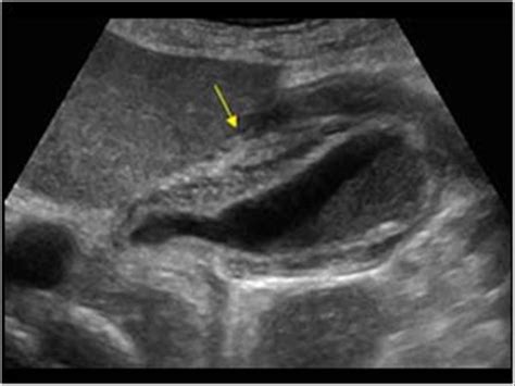 Gallbladder Disease Ultrasound