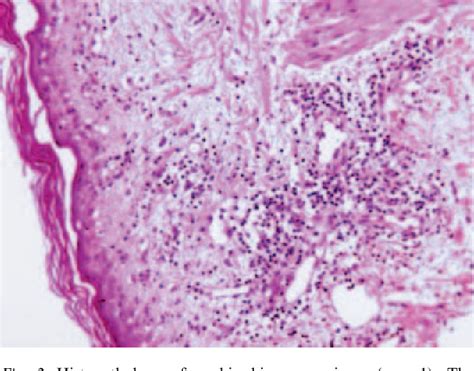 Figure 2 from Lansoprazole-induced subacute cutaneous lupus ...