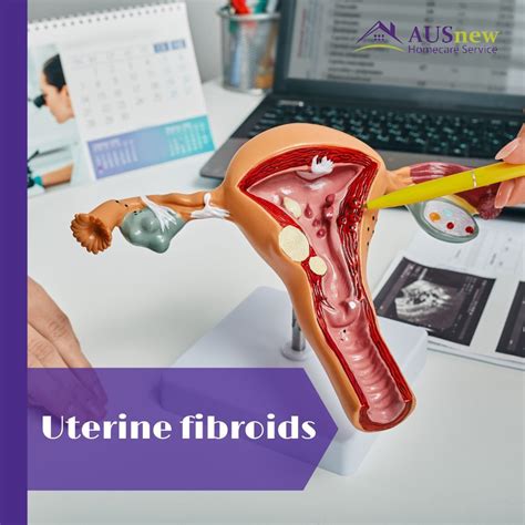 Uterine Fibroids Symptoms And Causes Artofit