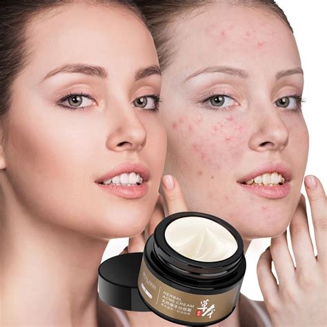 Skin Care Herbal Acne Cream Pock to Acne Treatment Products Whitening Pox Pits Pit Repair Cream ...