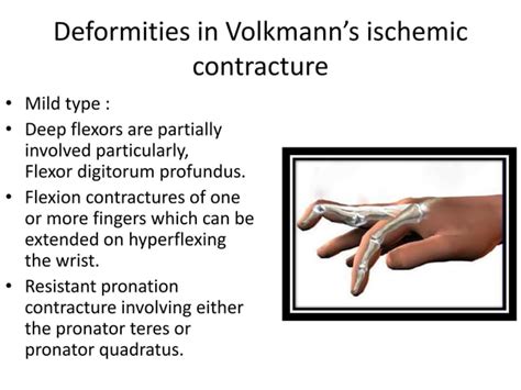 Volkmann¶s ischemic contracture