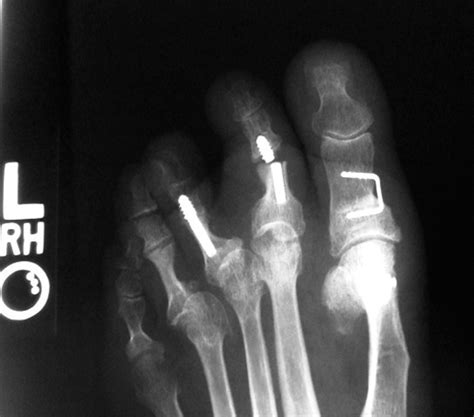 Radiographic Analysis Of Proximal Interphalangeal Joint Off