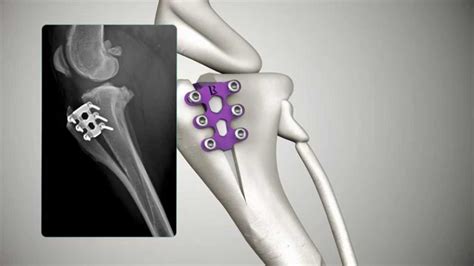 Tibial Tuberosity Advancement Tta Rapid Youtube