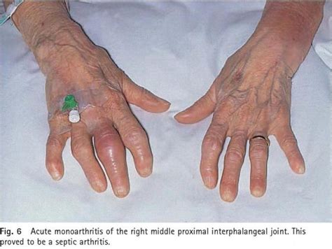 Acute Septic Monoarthritis Autoimmune Disease Psoriatic Arthritis