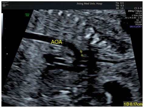 Diagnostic Accuracy Of Ultrasonography For The Prenatal Diagnosis Of