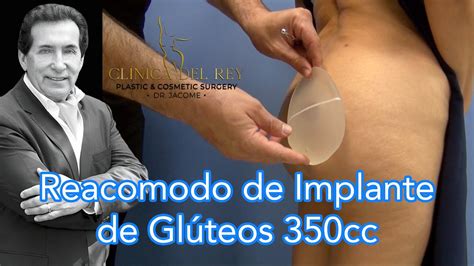 Reacomodo de Implantes de Glúteos 350cc en Clínica del Rey Dr Franco