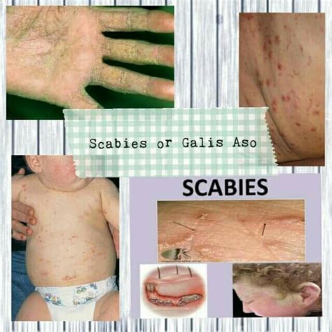 Best Seller Botanical Care Ointment Scabies Treatment For Human