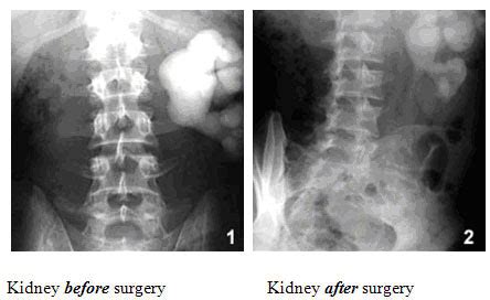 Pelvi-ureteric Junction (PUJ) Obstruction Dr. K. Ramesh – Chennai Urology