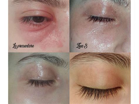 Before And After Derm One Clinic