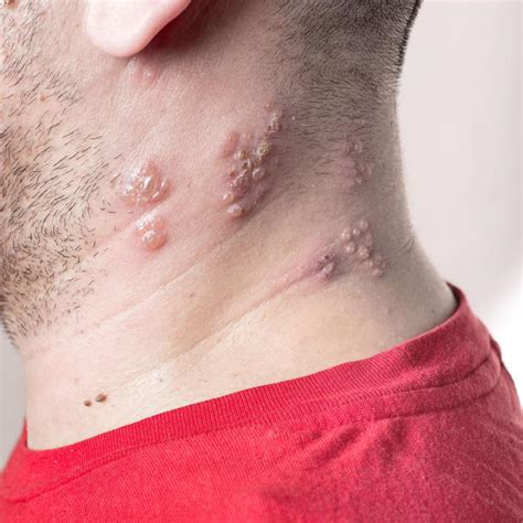 How Can I Tell The Difference Between Some Common Skin Rashes