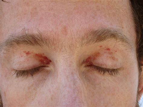 👉 Purpura - Pictures, Causes, Symptoms and Treatment (November 2021)